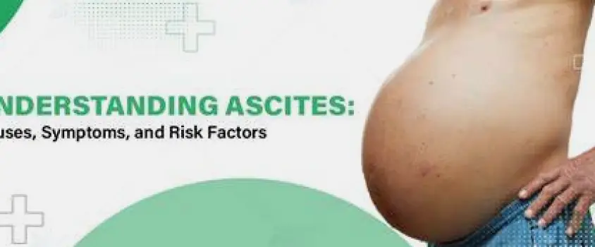 Abdomen showing pronounced swelling due to fluid accumulation (ascites)