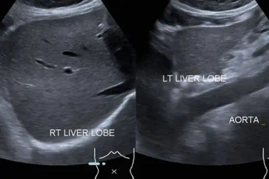 Clinician positioning an ultrasound probe over the right upper abdomen while viewing an image of the liver and gallbladder