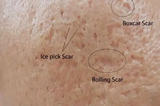 Close-up of skin showing small deep ice-pick scars, wave-like rolling scars, and round boxcar depressions with defined edges