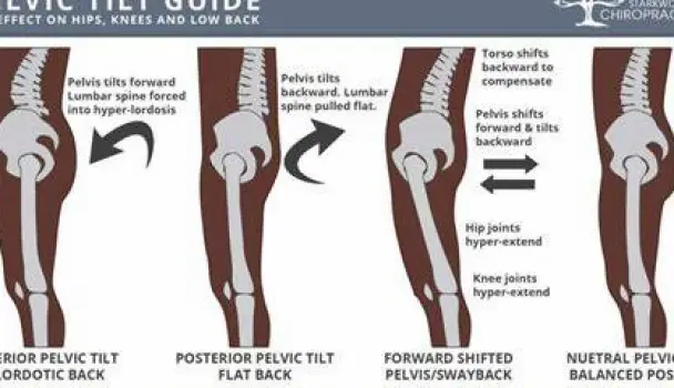 Side view comparison showing a person with anterior pelvic tilt (front of pelvis lower, back higher, increased lumbar curve) and a person with posterior pelvic tilt (front of pelvis higher, back lower, flattened lumbar curve)