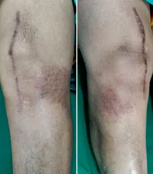 Red inflamed skin with small papules and vesicles on a knee joint showing topical gel dermatitis