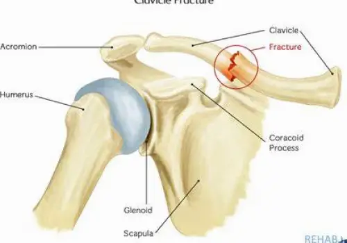 Illustration of a broken right clavicle showing a vertical fracture line and a gap between the bone fragments.
