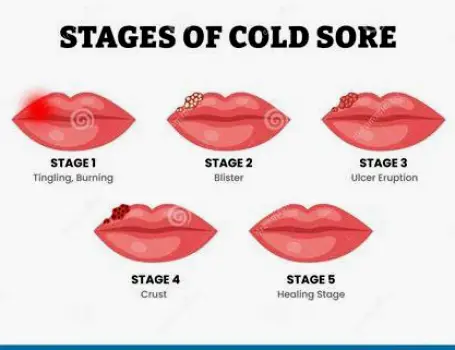 Cold sore on the lip in the crusting stage with a dry, scabbed surface