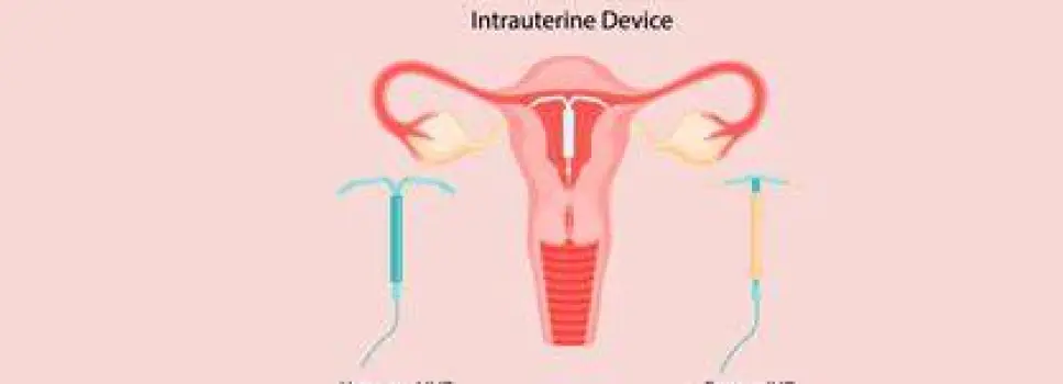 T-shaped copper intrauterine device with copper wire coiled around the vertical stem