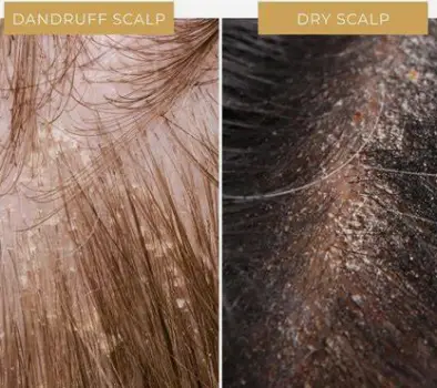 Scalp view with visible greasy yellow-white flakes and mild redness, indicating dandruff.