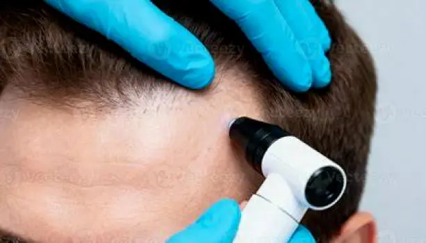 Dermatologist using a handheld dermatoscope to closely examine a patient's scalp and hair follicles for signs of thinning
