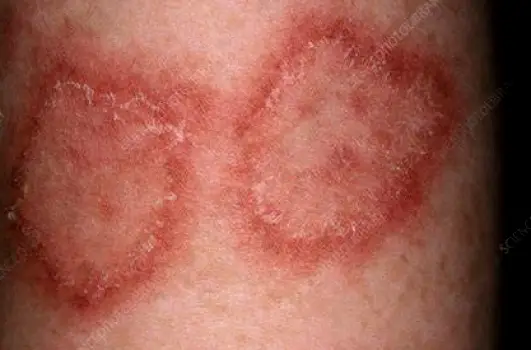 Thick, scaly discoid lupus plaques on a lower leg, showing a rough surface and potential scarring.