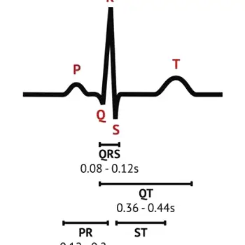 Computer monitor displaying an ECG tracing of heart rhythm