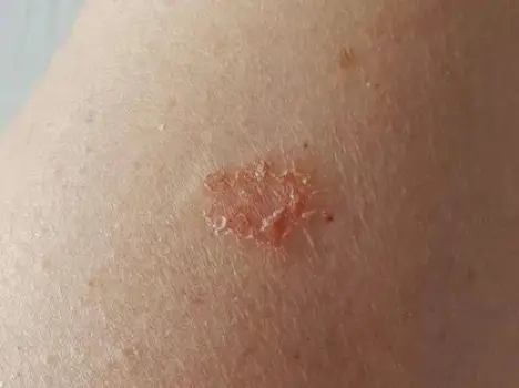 Inflamed, dry patch on a person's forearm resembling eczema