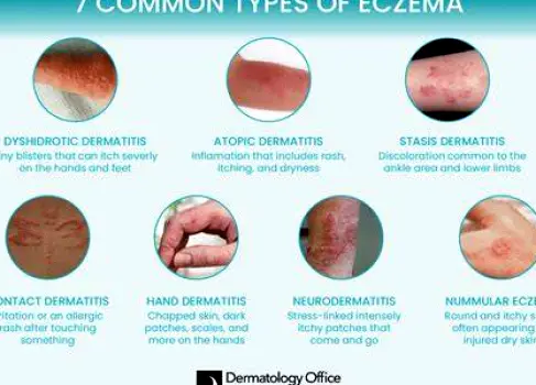 Patch of skin showing a raised eczema rash without a central punctum, illustrating lack of bite mark
