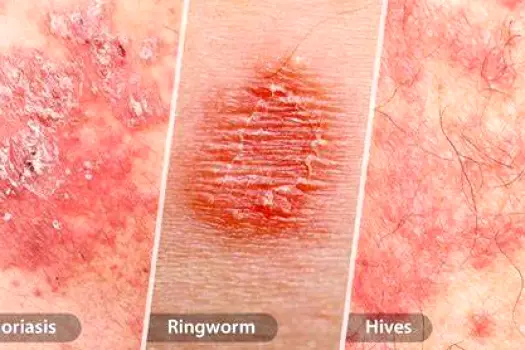 Patch of dry, irritated skin with a red, raised appearance, illustrating an eczema rash