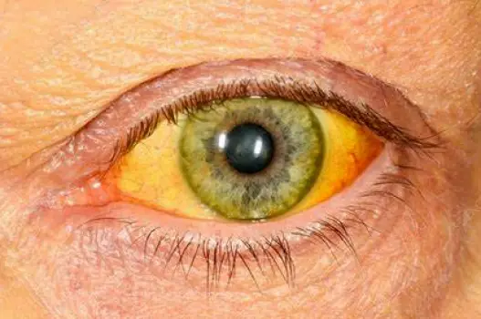Close-up of a person's eye showing yellowing, a visible sign of jaundice