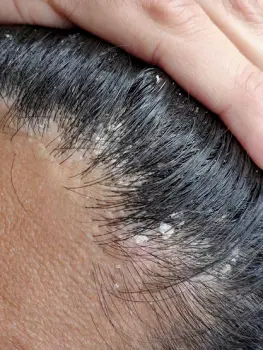 Close-up of flakes visible among hair strands at the scalp