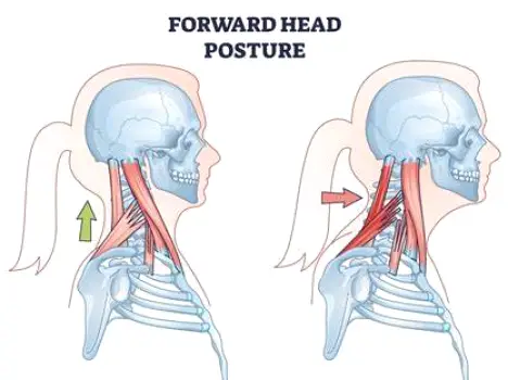 Person sitting at a desk with head tilted forward and down toward a smartphone, illustrating forward head posture