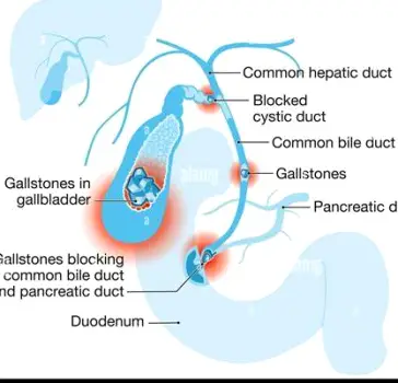 Gallstones blocking the common bile duct, causing bile flow obstruction