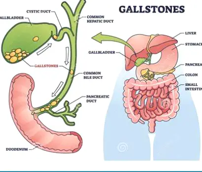 Close-up cross-section of a gallbladder containing visible gallstones