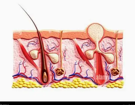 Cross-section of skin showing an infected hair follicle with a small collection of pus beneath the surface