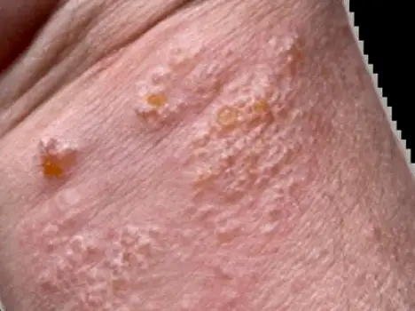 Hand with irritated skin showing redness, dryness, cracking, and small fluid-filled blisters on the fingers