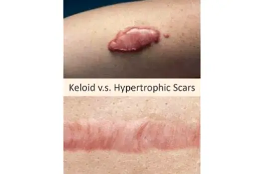 Side-by-side view of a raised hypertrophic scar confined to a wound site and a keloid scar extending beyond the original injury