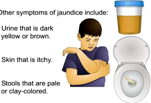 Close view of yellowing skin and the whites of the eyes displayed beside dark urine and pale stools