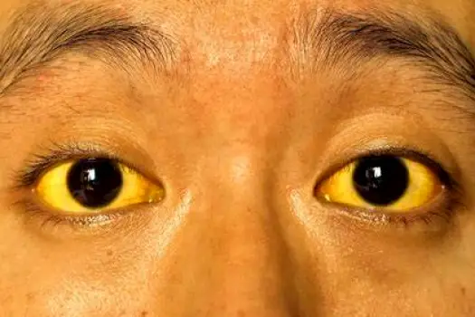 Yellow discoloration of the sclera and facial skin indicating jaundice from liver toxicity