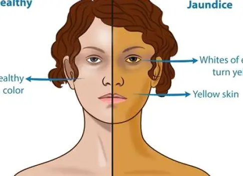 Close-up of a person's face showing yellowing of the whites of the eyes and skin indicative of jaundice