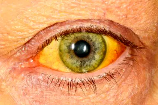 Close-up of a person's eye with yellowed sclera