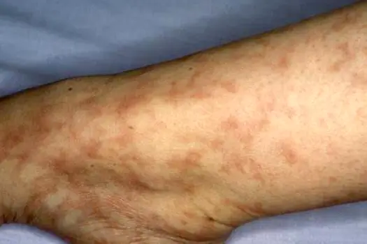 Lacy, netlike reddish-to-violet mottling of the skin on a lower leg characteristic of livedo reticularis.