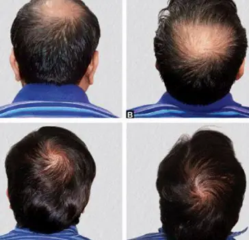 Top-down view of a man's head showing hair thinning concentrated at the crown or vertex area