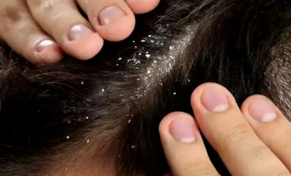 Close-up of hair with tiny, dry white flakes scattered evenly, easily brushed away.