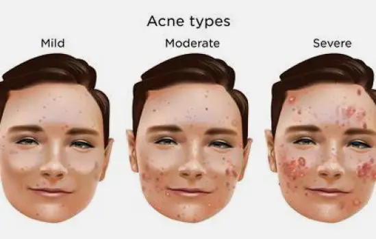 Close-up of a person's cheek showing mild red inflamed acne lesions and faint brown post-inflammatory dark marks.