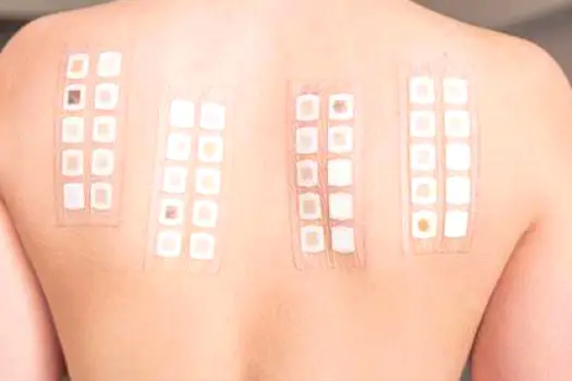 Close-up of a patch test area on a forearm skin