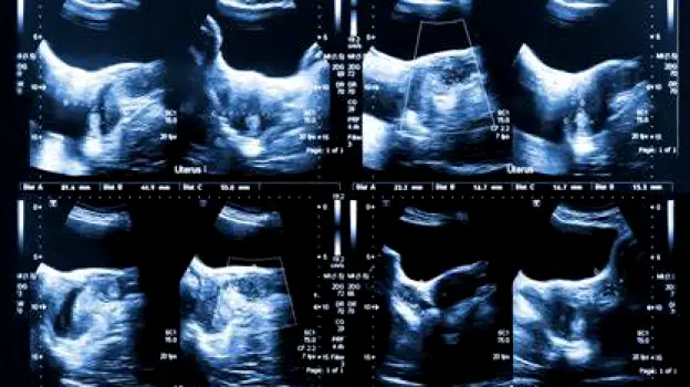 Healthcare professional performing a pelvic ultrasound to visualize the ovaries