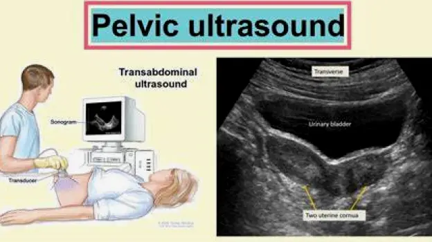Clinician performing a transabdominal pelvic ultrasound with the probe on the lower abdomen and a monitor displaying the pelvic organs