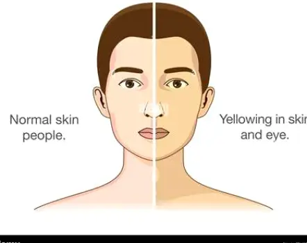 Close-up of a person's face showing yellowish discoloration of the skin and eyes