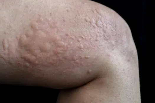 Close-up of a person examining a raised rash on their forearm