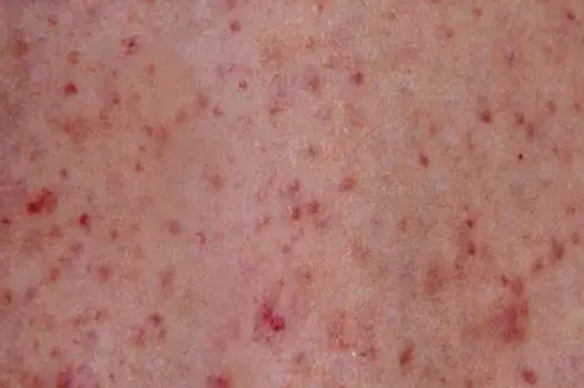 Tiny red-purple petechiae spots clustered on the upper chest and lower face of a person