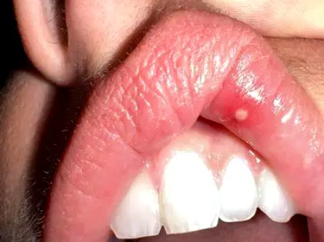 Close-up of a single inflamed bump with a visible white head on the skin bordering the lip
