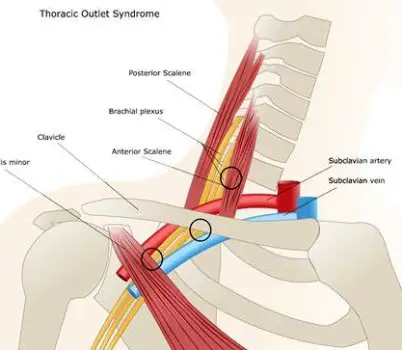 Illustration of the right thoracic outlet showing the clavicle, first rib, brachial plexus, subclavian artery and vein, with surrounding muscles and lymph nodes.