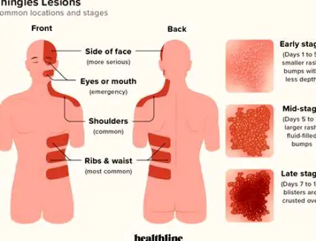 Skin on a chest area showing blistering rash characteristic of shingles