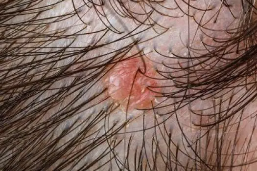 Close-up of a small red bump beside strands of hair at the hairline