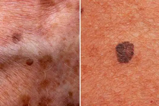 Close-up of one skin surface with a flat darker spot beside an adjacent indented scar
