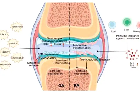 Illustration of a joint with thinning and frayed cartilage showing cartilage damage in stage 2 rheumatoid arthritis