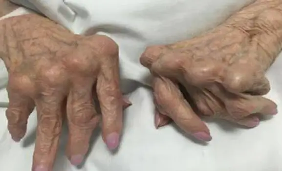 Photo of a hand showing joint swelling, enlargement, and early ulnar deviation from bone erosion in stage 3 rheumatoid arthritis