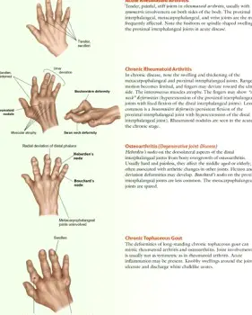 Photo of a hand with severe fixed deformities and fused joints (ankylosis) representing end-stage rheumatoid arthritis