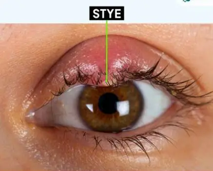 Close-up of a human eye showing a small, red lump at the edge of the eyelid margin.