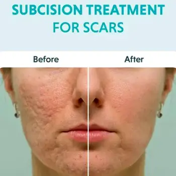 Medical illustration of a needle separating fibrous bands beneath the skin to release a rolling acne scar