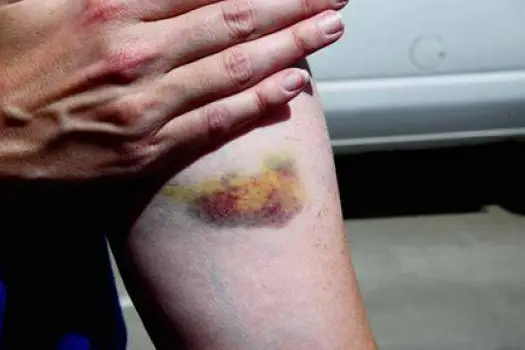 Unusual bruising visible on a person's skin