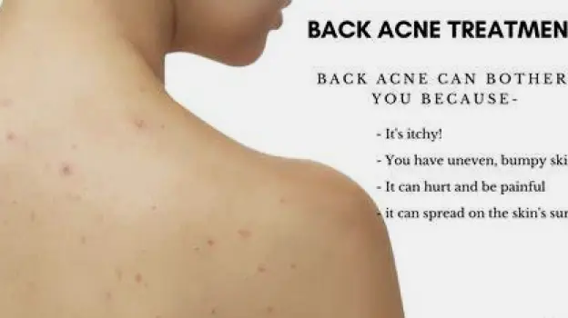 Upper back of a person with a few whiteheads, blackheads, and pimples visible on the skin