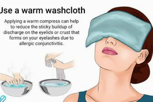A damp washcloth applied to skin as a warm compress to promote healing of an acne nodule